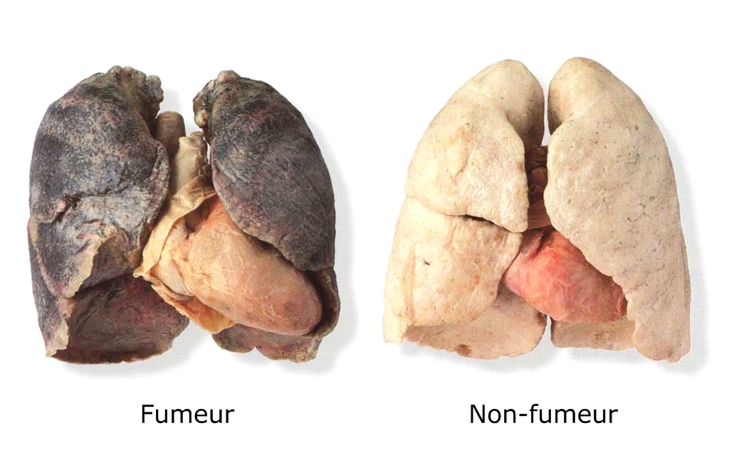 Affiche avec deux poumons, l'un ravagé de fumeur, l'autre sain, avec un fond transparent et en mode paysage, sans indications légales.